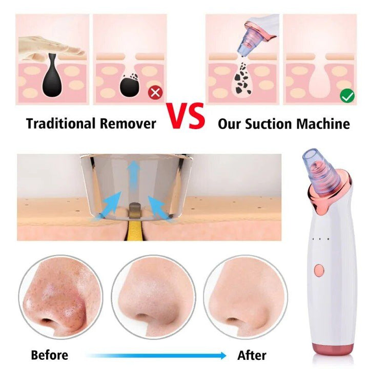 Electric Facial Vacuum Blackhead & Acne Remover with Deep Pore Cleansing